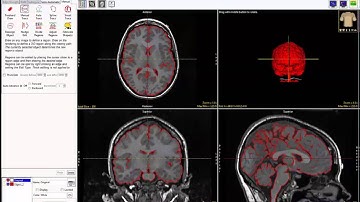 AnalyzePro: Brain Segmentation using Object Extractor