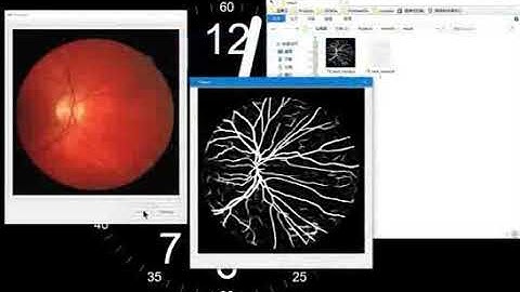 Retinal blood vessel segmentation in the eyeground