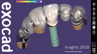 INSIGHTS 2018: DentalCAD Case Demonstration - Bridge with attachments and partial Part I screenshot 4