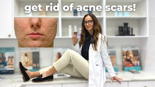 How to prevent and treat ACNE SCARS! Dr. Simona Bartos