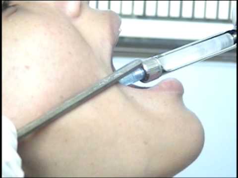 tecnica de gow gates. tecnica de gow gates.