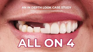 All-On-4 Dental Implants Treatment | An In Depth Look Case Study Dental Boutique