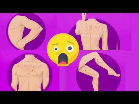 How to Get Rid of Body Acne, (Back acne, chest acne, leg acne, arm acne)