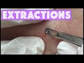 This Week's Extractions!