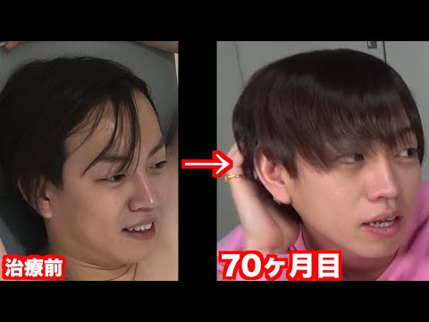 【ハゲ日記】AGA薄毛治療70ヶ月目！