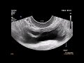 Двустороннее уретероцеле/Bilateral ureterocele