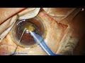 Management of a hard cataract by galaxy pro orbit  pradip mohanta 6th april 2024