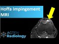 Hoffa Impingement Syndrome on MRI