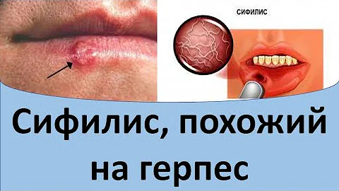 Сифилис, похожий на герпес