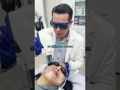 Cómo tratar el acné con Láser Accure  #acne