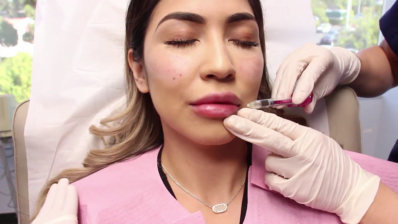 Banner for Corrected Lip Filler Injections by Dr. Wu