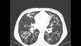 Cystic Fibrosis (Axial - Lung Windows - 10 FPS)