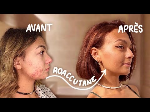COMMENT ROACCUTANE A CHANGÉ MA PEAU