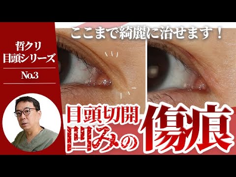 Epicanthoplasty scars] Explaining how to correct scars. How to