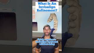 What is an Invisalign refinement? And why it’s important.