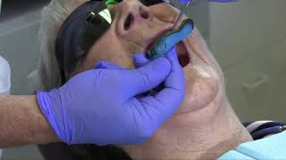 Border Molding for Complete Dentures