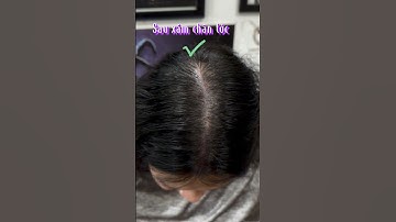Các chị gái tóc thưa do rụng xem ngay đi nhé kể cả các anh #hói_đầu #reviewxămtóc