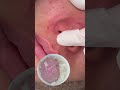 #asmr #asmrsounds #毛穴洗浄#角栓#毛穴吸引 #大阪天王寺