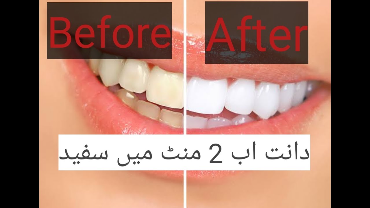 How to whiten teeth in 2 minutes Stop bleeding from teeth teeth