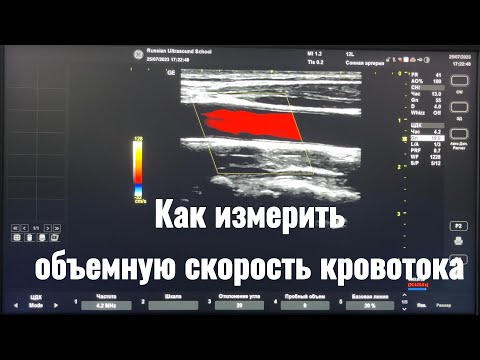 КАК ИЗМЕРИТЬ ОБЪЕМНУЮ СКОРОСТЬ КРОВОТОКА В АРТЕРИЯХ