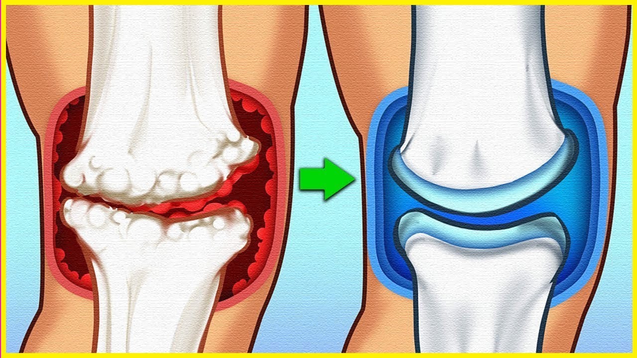 Harga Artrivit Di Apotik | Artrivit Obat Apa