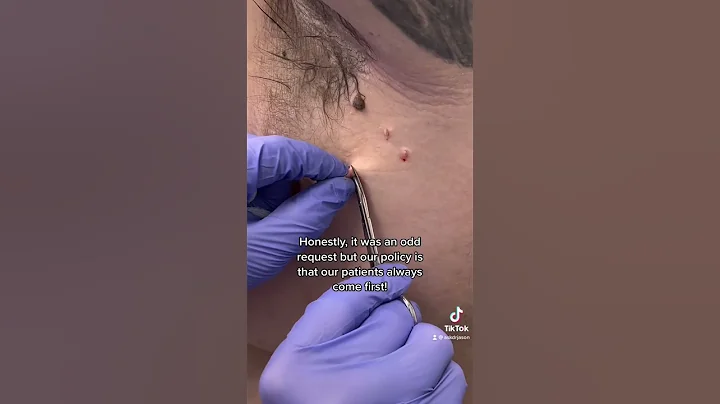 How to Add Skin Tags #shorts #skintags