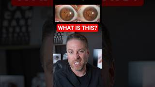 Persistent Pupillary Membrane Pictures! @DrEyeGuy