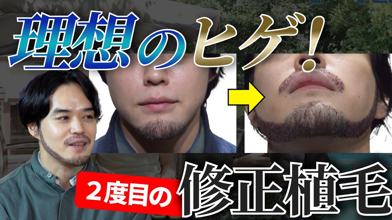 【髭が薄い人必見】日本とトルコで髭植毛してみた！2度目の体験談＆徹底比較【トルコ髭植毛・体験者のリアルインタビュー】 YouTube