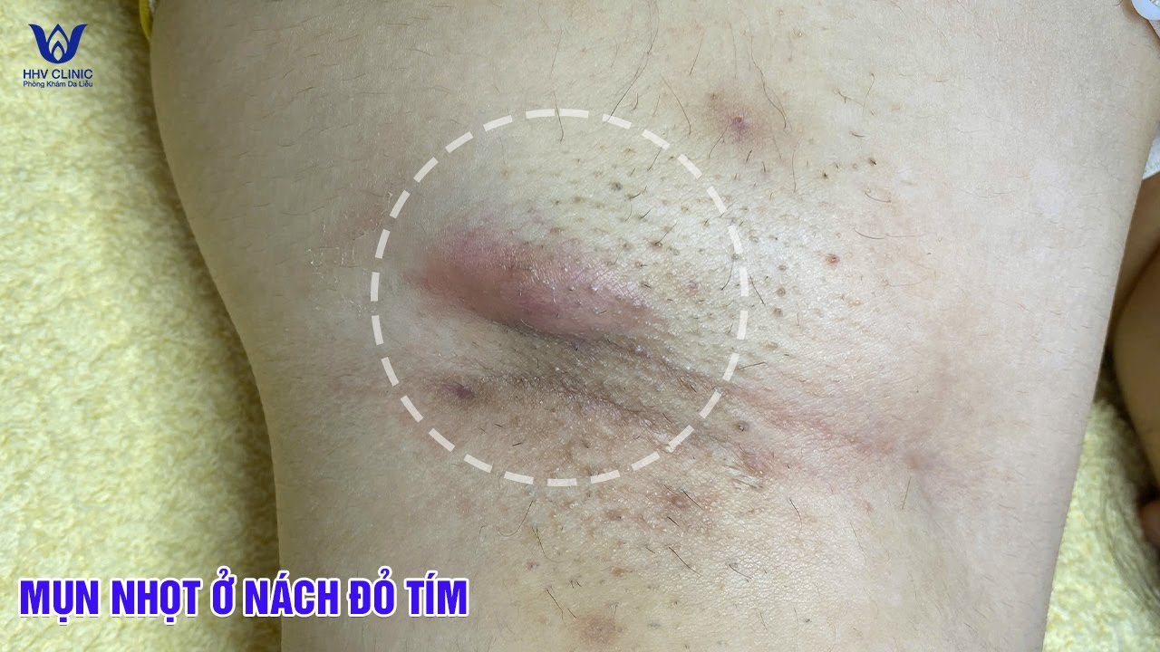 Mụn nhọt nách đỏ tím đau nhức điều trị đúng cách mới khỏi , không tái lại.