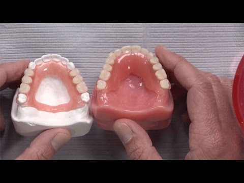 Case of the week: Never Before Seen Partial Denture Material