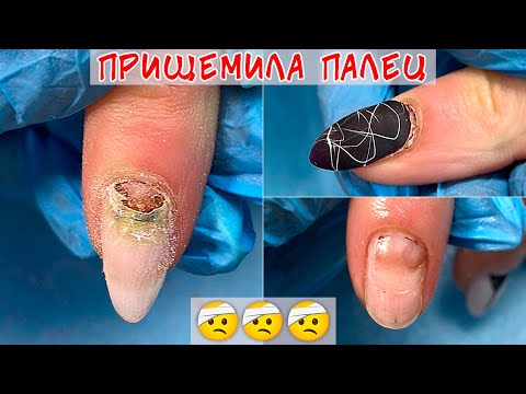 Прищемила палец на руке / Позеленел ноготь под гелем😨