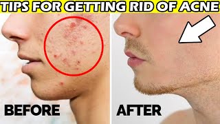 ✅Tips for getting rid of acne ||  loan nguyen acne treatment