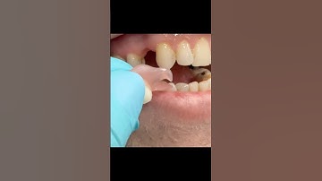Flipper- Quick Temporary Replacement of a Missing Tooth​⁠ #flipper #missingtooth  #toothreplacement