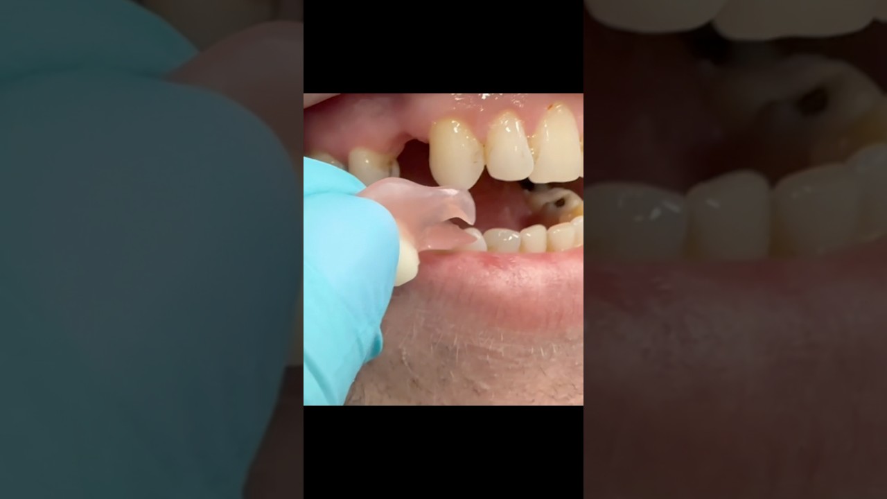 Flipper- Quick Temporary Replacement of a Missing Tooth​⁠ 