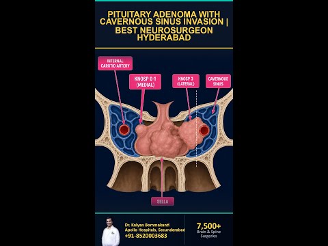 Cavernous Sinus Pituitary Tumour: Operable? - Best Pituitary Surgeon in Hyderabad | తెలుగు