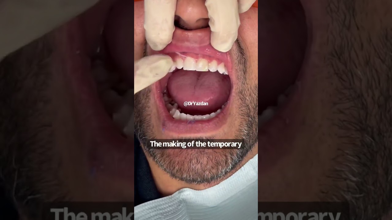 Porcelain veneers procedure | porcelain veneers before and after | porcelain veneers front teeth