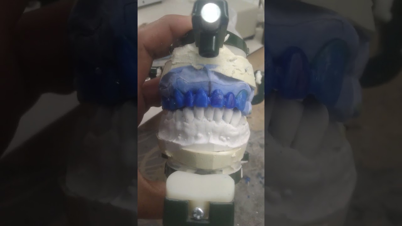 9 units porcelain fuse to metal. fixed bridge.  for wax pattern