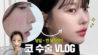 코수술 부작용?!😱수술 당일부터 한 달차까지 꽉 채운 VLOG👃🏻+ 효과 대박인 붓기 관리템,수술 후 일상✨