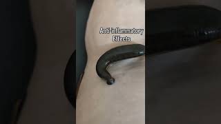 #LeechTherapy#Jalaukavacharana#VaricoseVeinsTreatment#AyurvedaCure#BloodPurification#Raktamokshana