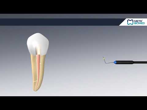 Meta Biomed EQV Endodontic Obturation System - How To Use - DENTBEAR ...