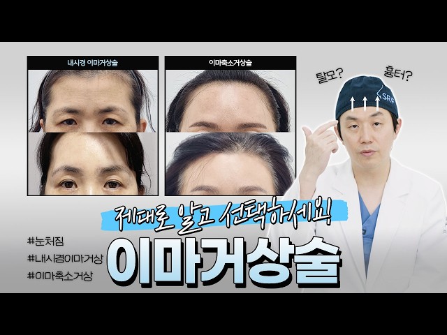 이마거상술, 어떤 방법이 맞을까?✔ (내시경 이마거상 vs 이마축소거상 차이)