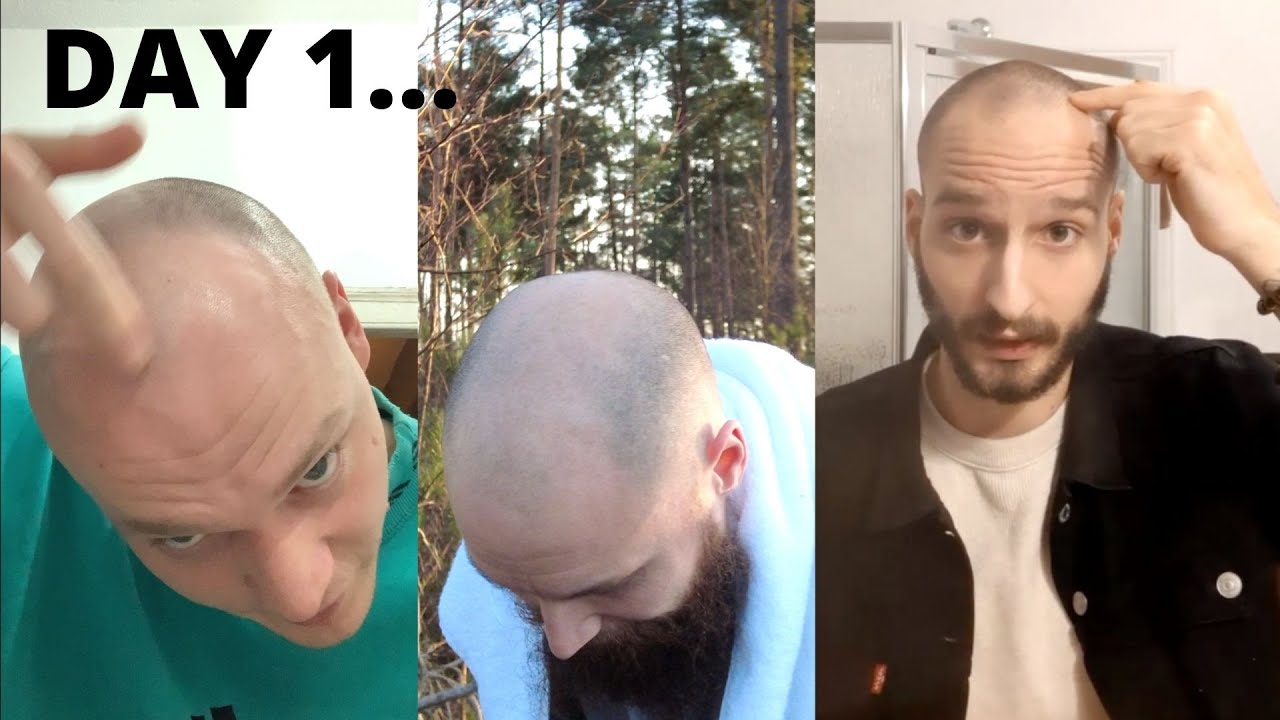 Bald Men Prepare To Grow Hair Out To Reduce Stigma Around Balding YouTube