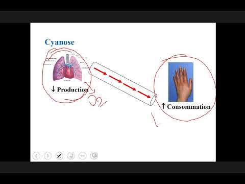 Cardiopathie congénitale