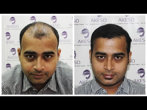 AKESO Hair transplant REVIEW - Mr Amit - YouTube