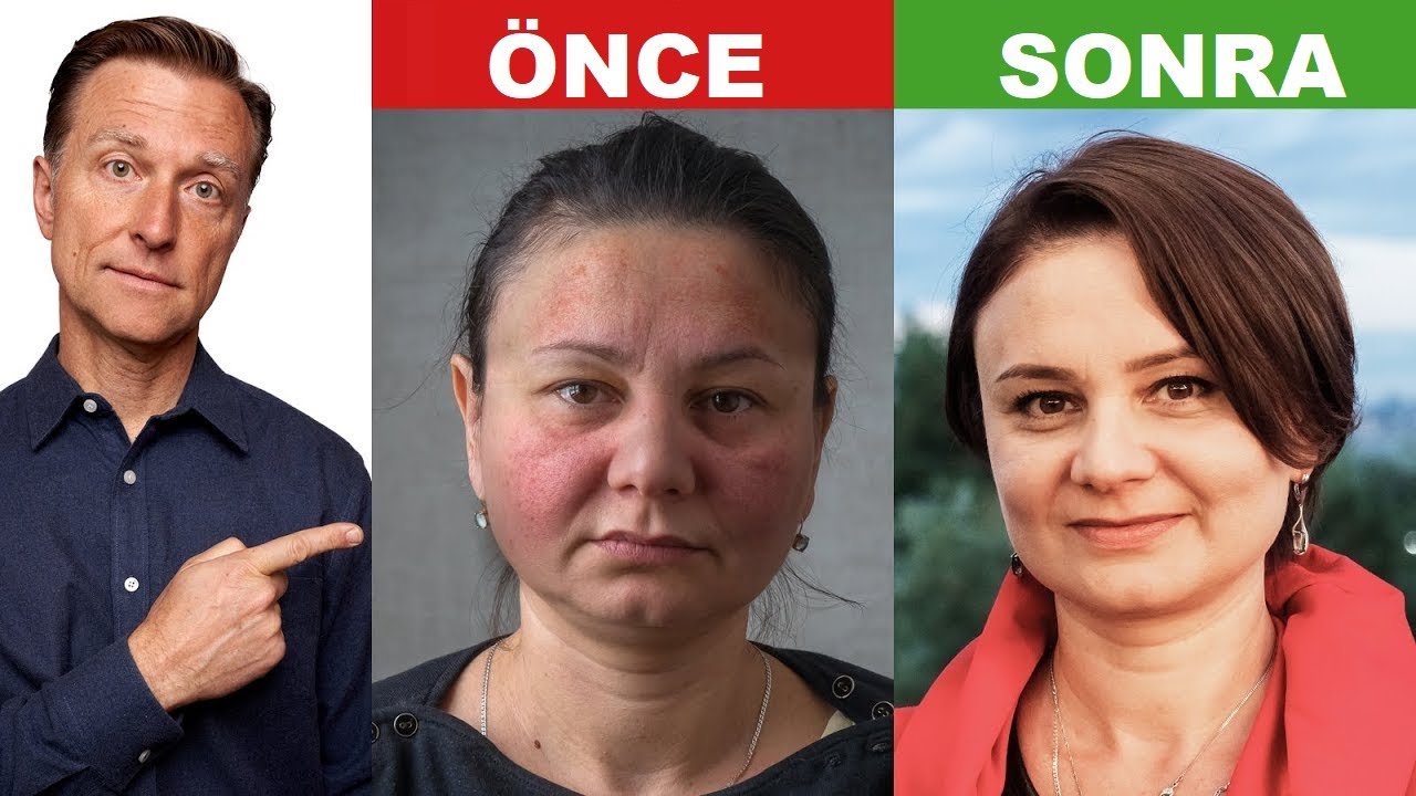 Otoimmün Hastalığınızı Nasıl Remisyona Sokarsınız? | Dr.Berg Türkçe