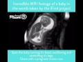 MRI Scan Video of Baby Moving in Womb | Channel Mum