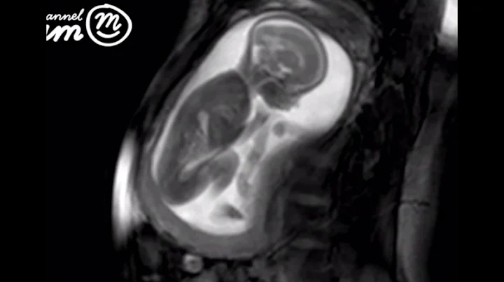 MRI Scan Video of Baby Moving in Womb | Channel Mum