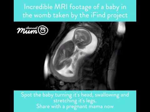MRI Scan Video of Baby Moving in Womb | Channel Mum