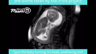 Video Pemindaian MRI Bayi Bergerak dalam Kandungan | Saluran Ibu