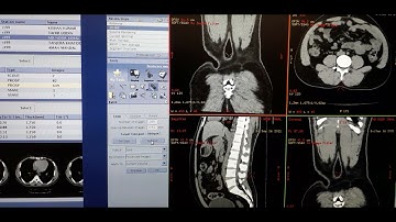 NCCT  KUB FILMING ON GE CT SCAN 16 SLICE